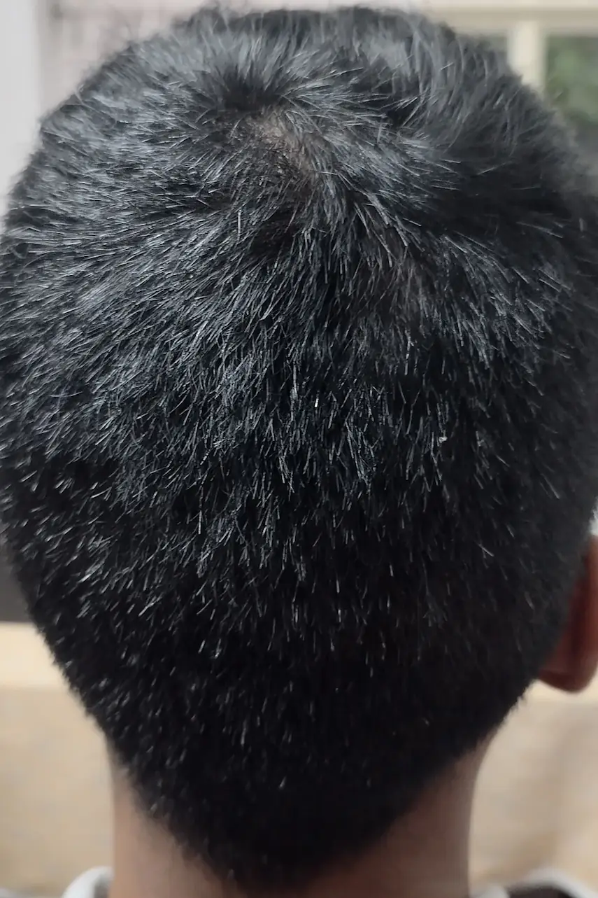 After homoeopathic treatment for Alopecia Treatment - Priya S. - Successful Recovery After treatment - Priya S.