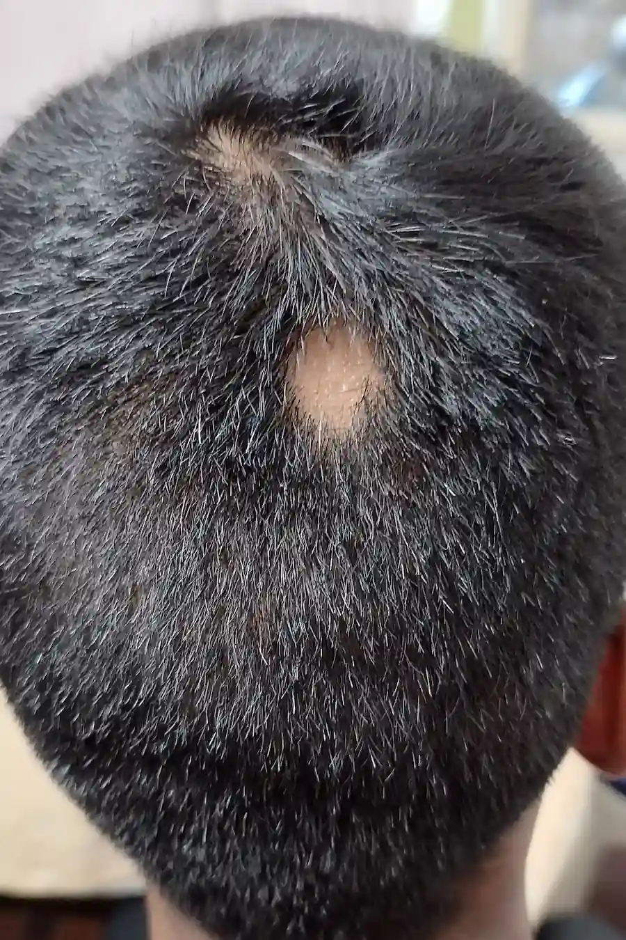 Before homoeopathic treatment for Alopecia Treatment - Priya S. Before treatment - Priya S.